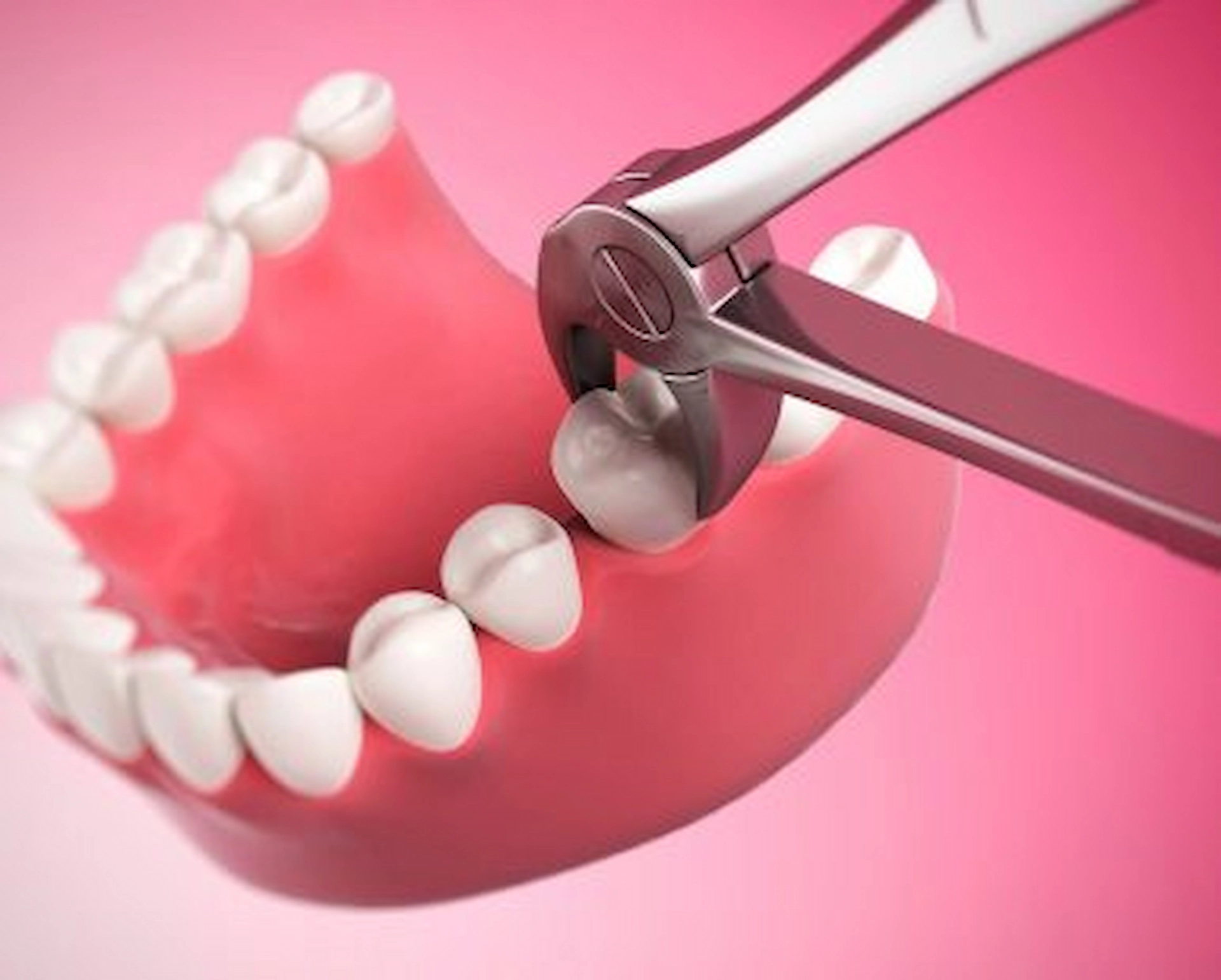 Wisdom-Tooth Extraction